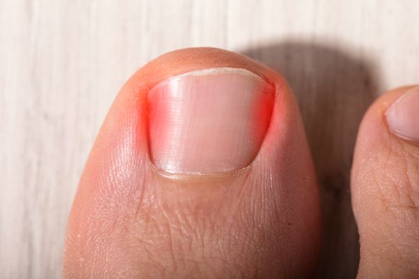 Ingrown Toe Nails